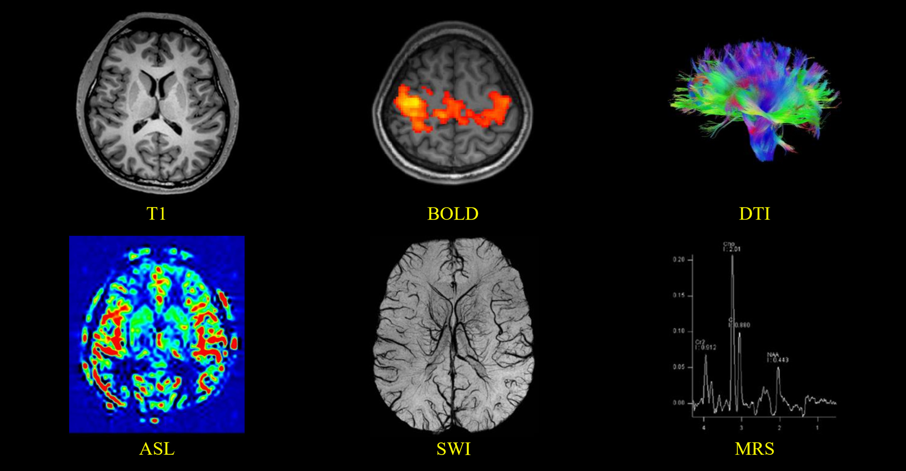 MRI